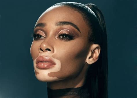 porn stars with vitiligo